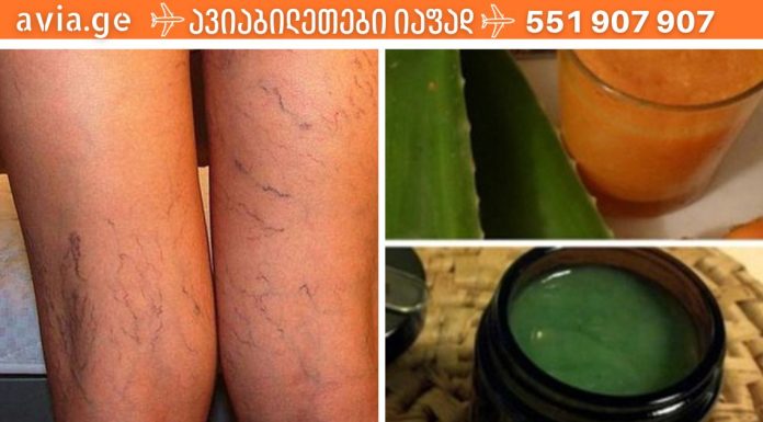 ეს ძველი ხალხური რეცეპტი შეამცირებს ვარიკოზული ვენების სიმპტომებს