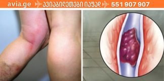 თრომბოზის საშიში ნიშნები, რომლებმაც შეიძლება ძალიან ცუდი შედეგები გამოიწვიოს
