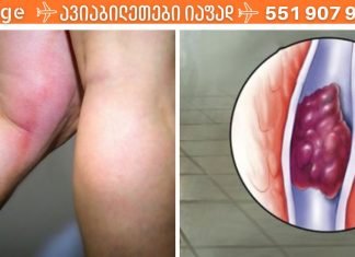 თრომბოზის საშიში ნიშნები, რომლებმაც შეიძლება ძალიან ცუდი შედეგები გამოიწვიოს