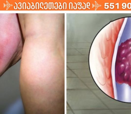 თრომბოზის საშიში ნიშნები, რომლებმაც შეიძლება ძალიან ცუდი შედეგები გამოიწვიოს