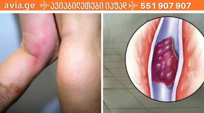 თრომბოზის საშიში ნიშნები, რომლებმაც შეიძლება ძალიან ცუდი შედეგები გამოიწვიოს