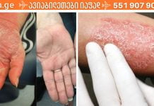 ნიშნები,რომლებსაც ყურადღება უნდა მიაქციოთ ფსორიაზის დროს