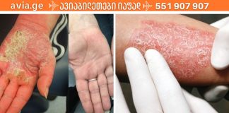 ნიშნები,რომლებსაც ყურადღება უნდა მიაქციოთ ფსორიაზის დროს
