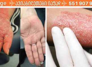 ნიშნები,რომლებსაც ყურადღება უნდა მიაქციოთ ფსორიაზის დროს