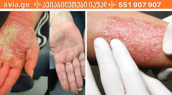 ნიშნები,რომლებსაც ყურადღება უნდა მიაქციოთ ფსორიაზის დროს