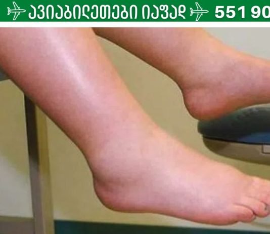 როგორ მოვიშოროთ ფეხების შეშუპება: 11 მარტივი რჩევა