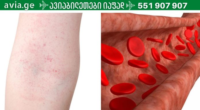 რა უნდა გავაკეთოთ სისხლძარღვებს ელასტიურიბა და სიჯანსაღე რომ დავუბრუნოთ?