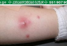 ფურუნკულების (ძირმაგარების) სახლში მკურნალობის გზები.