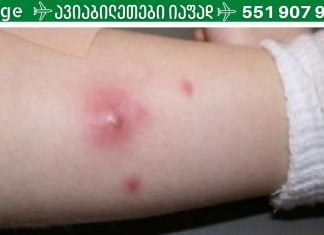 ფურუნკულების (ძირმაგარების) სახლში მკურნალობის გზები.
