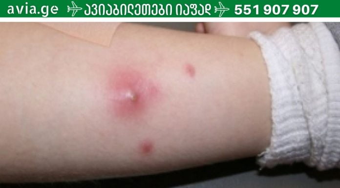 ფურუნკულების (ძირმაგარების) სახლში მკურნალობის გზები.