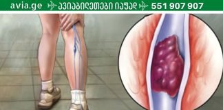 სასიცოცხლოდ მნიშვნელოვანია,რა უნდა იცოდეთ თრომბის შესახებ