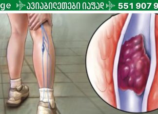 სასიცოცხლოდ მნიშვნელოვანია,რა უნდა იცოდეთ თრომბის შესახებ