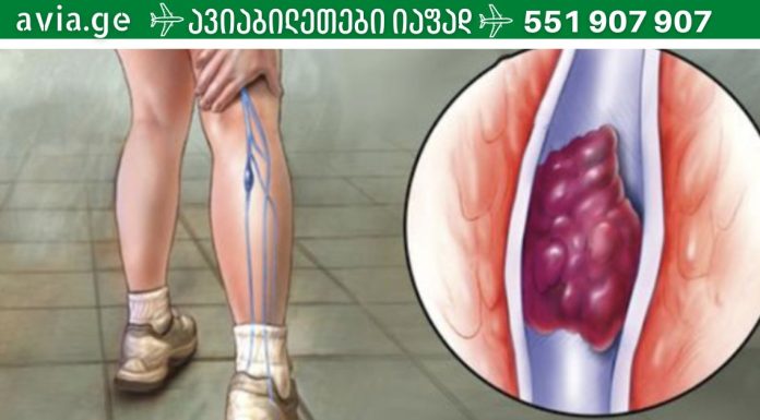 სასიცოცხლოდ მნიშვნელოვანია,რა უნდა იცოდეთ თრომბის შესახებ