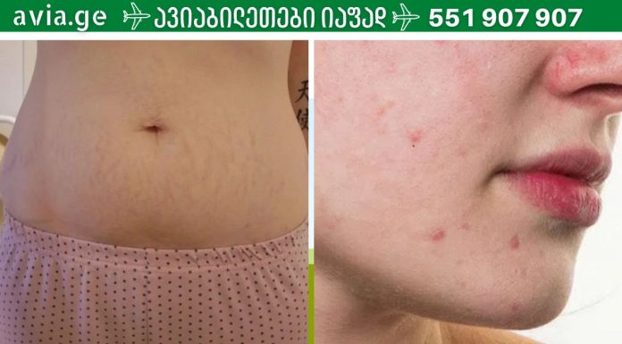 ნაწიბურების და სტრიებისთვის ეს საშუალება შეუდარებელია