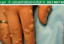 ეს მეთოდები ბებიაჩემის დამ მასწავლა, როდესაც ჩემს ხელებზე მეჭეჭები დაინახა.