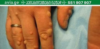 ეს მეთოდები ბებიაჩემის დამ მასწავლა, როდესაც ჩემს ხელებზე მეჭეჭები დაინახა.