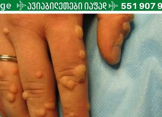 ეს მეთოდები ბებიაჩემის დამ მასწავლა, როდესაც ჩემს ხელებზე მეჭეჭები დაინახა.