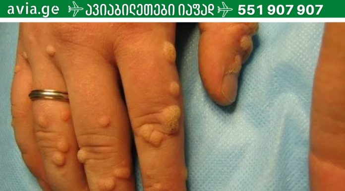 ეს მეთოდები ბებიაჩემის დამ მასწავლა, როდესაც ჩემს ხელებზე მეჭეჭები დაინახა.