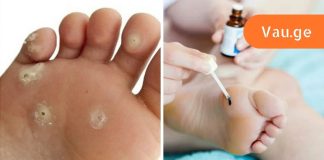 6 გზა პლანტარული მჭეეჭებისგან თავის დასაღწევად