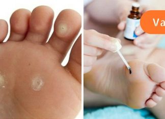 6 გზა პლანტარული მჭეეჭებისგან თავის დასაღწევად