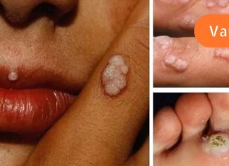 ბევრს არ ესმის, რომ ამ ვირუსის მატარებელია! აი, ეს არის საშინელი დაავადებების მიზეზი