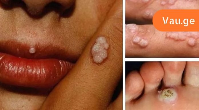 ბევრს არ ესმის, რომ ამ ვირუსის მატარებელია! აი, ეს არის საშინელი დაავადებების მიზეზი