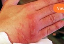 პირველი დახმარების წესები მდუღარე წყალით ან ორთქლით დამწვრობისას