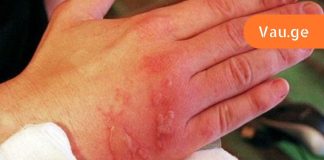 პირველი დახმარების წესები მდუღარე წყალით ან ორთქლით დამწვრობისას