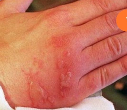 პირველი დახმარების წესები მდუღარე წყალით ან ორთქლით დამწვრობისას