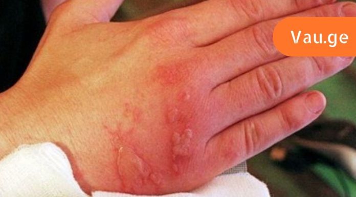 პირველი დახმარების წესები მდუღარე წყალით ან ორთქლით დამწვრობისას