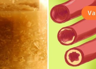 სისხლძარღვებს ამაზე უკეთესად ვერცერთი მედიკამენტით გაიწმინდავთ,ნახეთ კურკუმას და ძმრის საოცარი თვისებების შესახებ