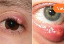 როგორ მოვიშოროთ ჯიბლიბო თვალიდან,ხალხური მედიცინის აღიარება.