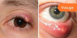 როგორ მოვიშოროთ ჯიბლიბო თვალიდან,ხალხური მედიცინის აღიარება.
