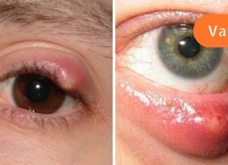როგორ მოვიშოროთ ჯიბლიბო თვალიდან,ხალხური მედიცინის აღიარება.