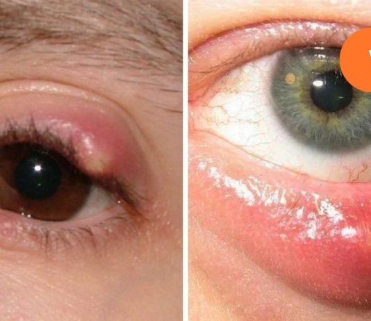 როგორ მოვიშოროთ ჯიბლიბო თვალიდან,ხალხური მედიცინის აღიარება.