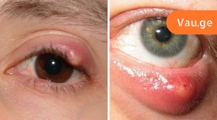 როგორ მოვიშოროთ ჯიბლიბო თვალიდან,ხალხური მედიცინის აღიარება.