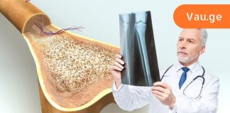 მყიფე ძვლები: როგორ ამოვიცნოთ და დავამარცხოთ ოსტეოპოროზი. ძალიან მნიშვნელოვანია კალციუმის შენარჩუნება.