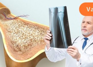 მყიფე ძვლები: როგორ ამოვიცნოთ და დავამარცხოთ ოსტეოპოროზი. ძალიან მნიშვნელოვანია კალციუმის შენარჩუნება.