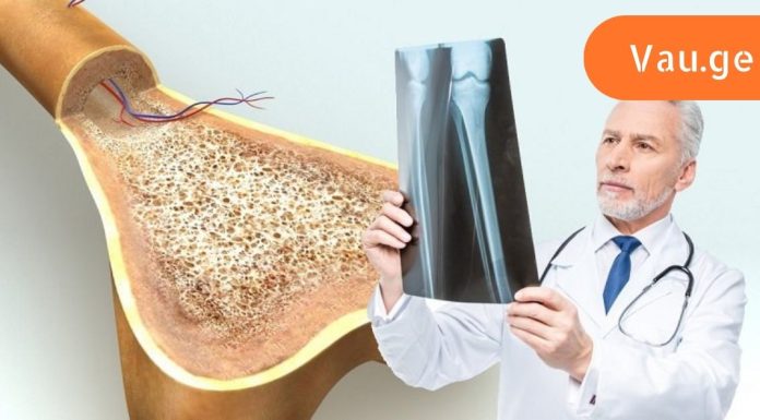 მყიფე ძვლები: როგორ ამოვიცნოთ და დავამარცხოთ ოსტეოპოროზი. ძალიან მნიშვნელოვანია კალციუმის შენარჩუნება.