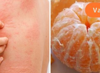 რატომ არის ზომიერება მნიშვნელოვანი მანდარინის ჭამის დროს? ყურადღება მიაციეთ დაავადებების ჩამონათვალს