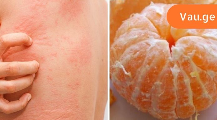 რატომ არის ზომიერება მნიშვნელოვანი მანდარინის ჭამის დროს? ყურადღება მიაციეთ დაავადებების ჩამონათვალს