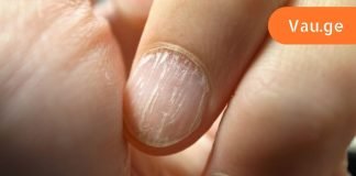 ეს ნიშნები მიგანიშნებთ რომ ორგანიზმს ცილა აკლია,იხილეთ ვრცლად…