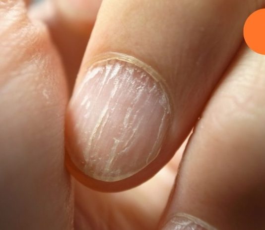 ეს ნიშნები მიგანიშნებთ რომ ორგანიზმს ცილა აკლია,იხილეთ ვრცლად…