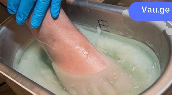 სოკო გაქრება! აიღეთ დაგამოიყენეთ ეს მეთოდები.