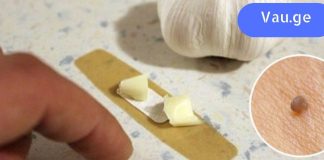 სოფლის მკურნალმა მირჩია ნივრის წასმა. მეჭეჭები არასოდეს გამქრობია ასე სწრაფად!