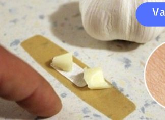 სოფლის მკურნალმა მირჩია ნივრის წასმა. მეჭეჭები არასოდეს გამქრობია ასე სწრაფად!