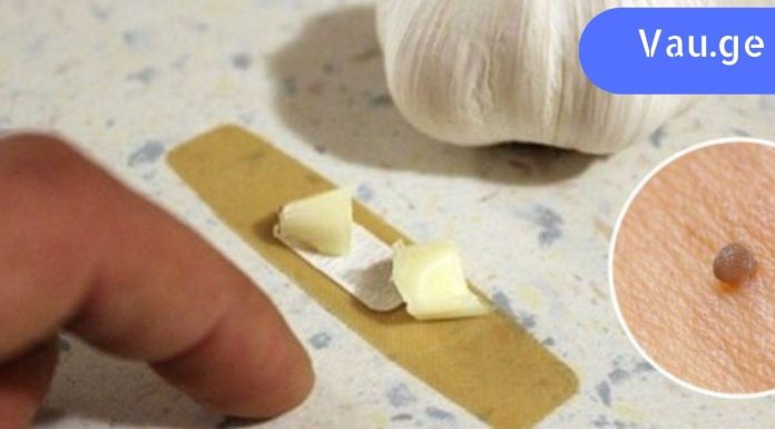 სოფლის მკურნალმა მირჩია ნივრის  წასმა. მეჭეჭები არასოდეს გამქრობია ასე სწრაფად!