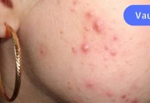 მას ეგონა, რომ აკნე ჰორმონალური იყო. ექიმი დადუმდა, როცა მიკროსკოპთან დაჯდა!