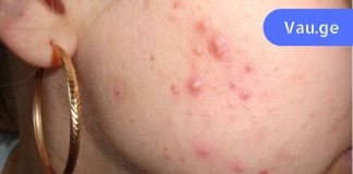 მას ეგონა, რომ აკნე ჰორმონალური იყო. ექიმი დადუმდა, როცა მიკროსკოპთან დაჯდა!