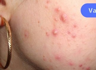 მას ეგონა, რომ აკნე ჰორმონალური იყო. ექიმი დადუმდა, როცა მიკროსკოპთან დაჯდა!